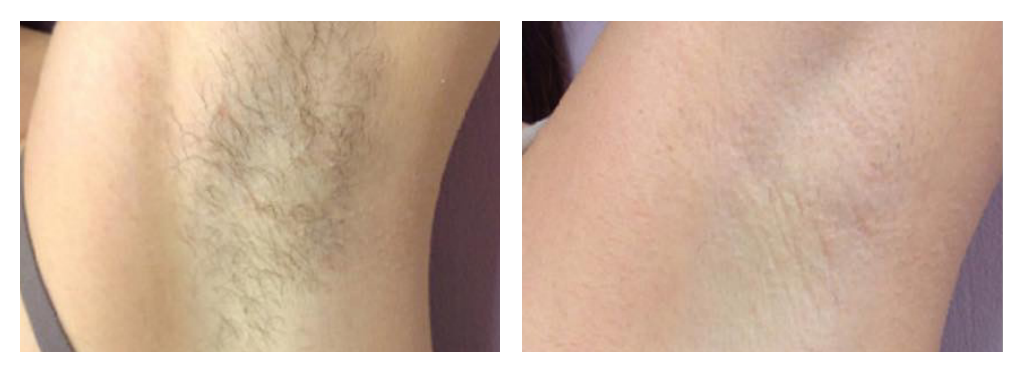 laser-hair-removal-before-after-wsc