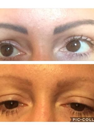Before and After semi perminent eyebrow removal