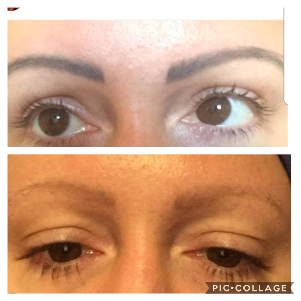 Before and After semi perminent eyebrow removal